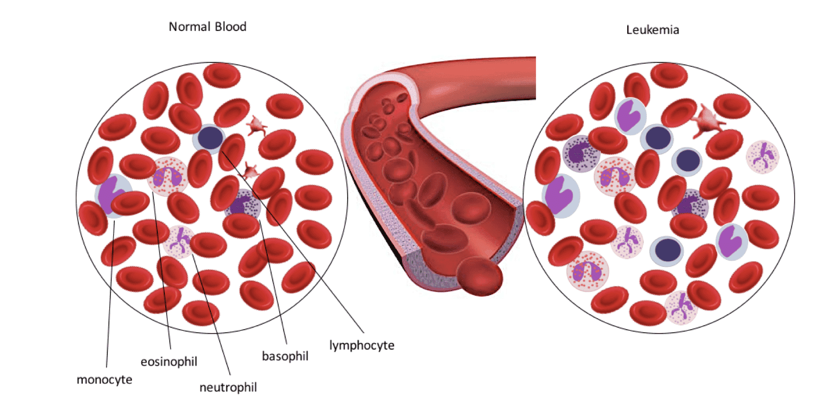 Fig.1 A schematic diagram on the differences in blood cell composition between leukemic and healthy individuals (Creative Biolabs Original)